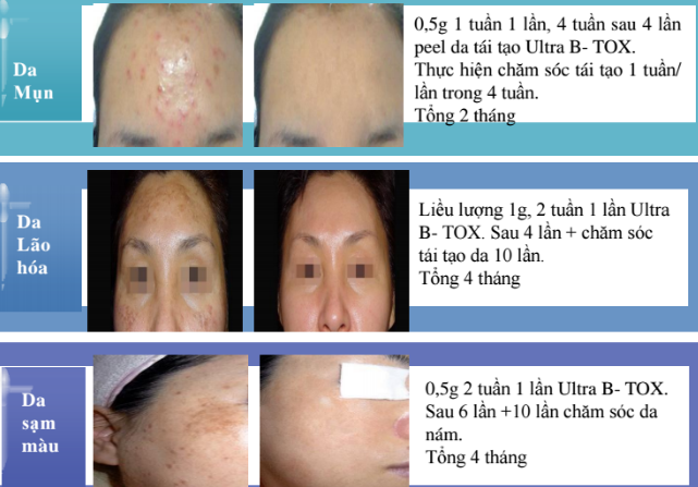 sử dụng vi kim tảo biển bao nhiêu là đủ